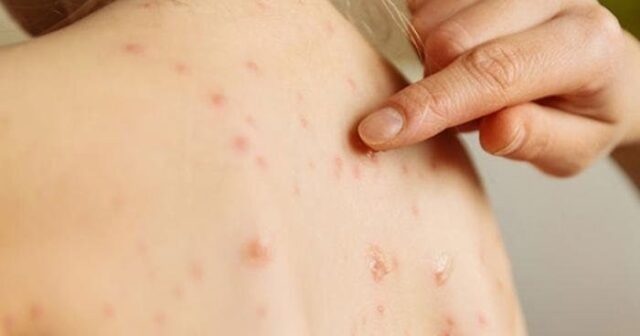 Suçiçəyi xəstəliyi son vaxtlar artır- Ekspertdən AÇIQLAMA